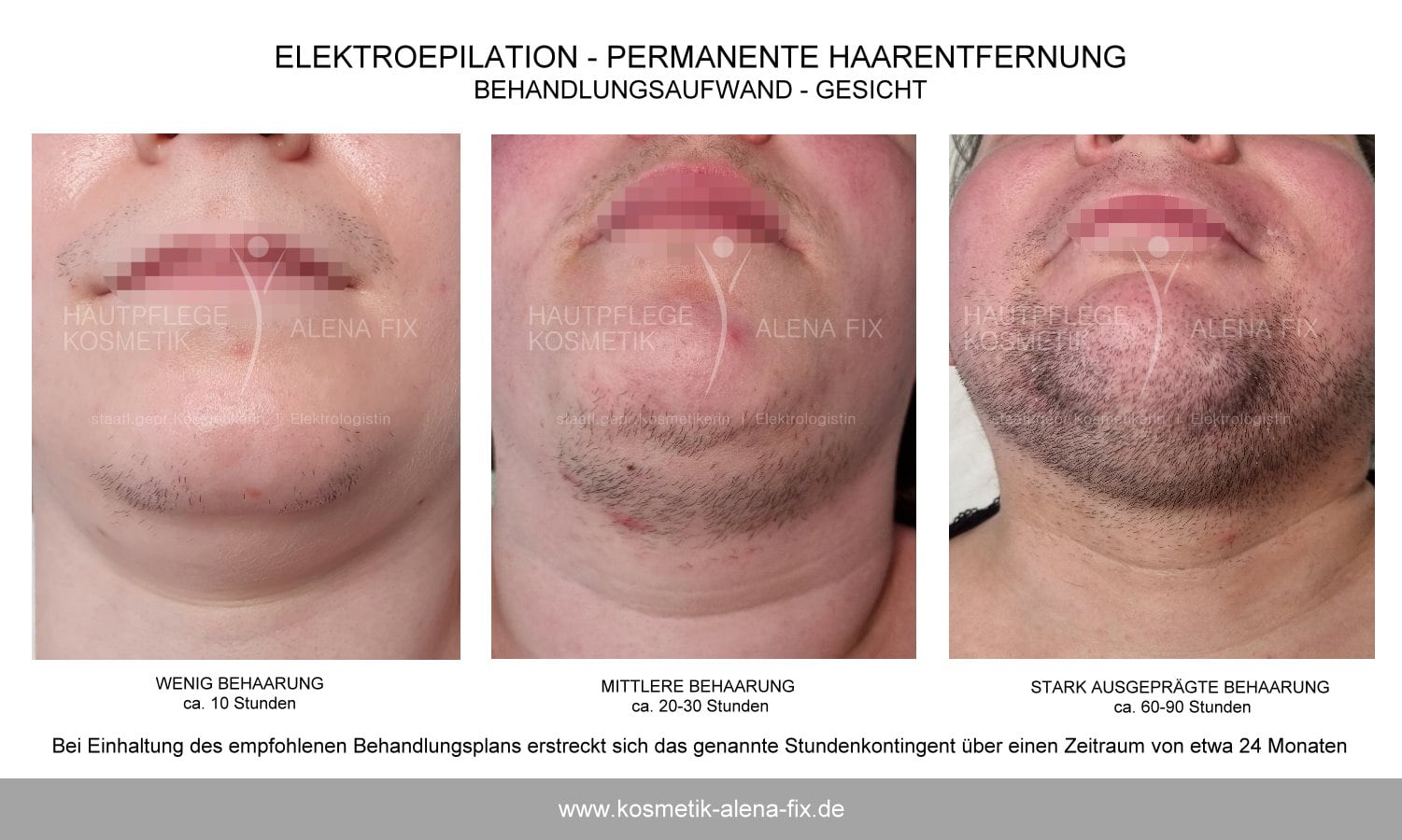 Elektroepilation  Gesicht Erfahrungen